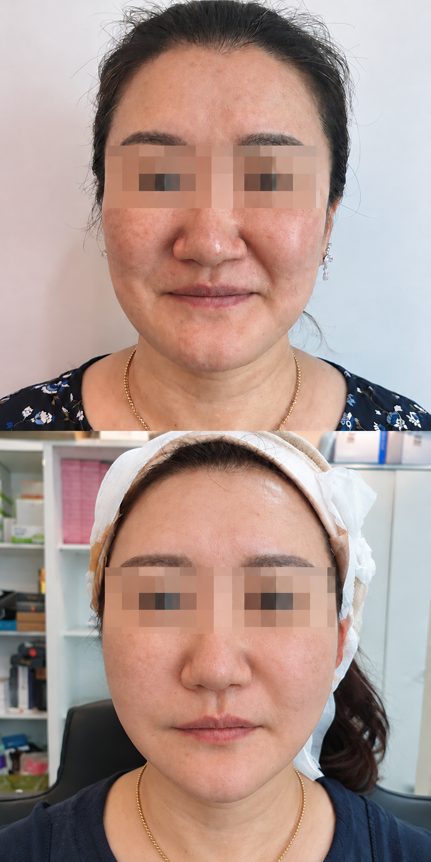 Before and after thread lift and tone refresh at The Boom Dermatology, a skin clinic in Busan Seomyeon, case 9