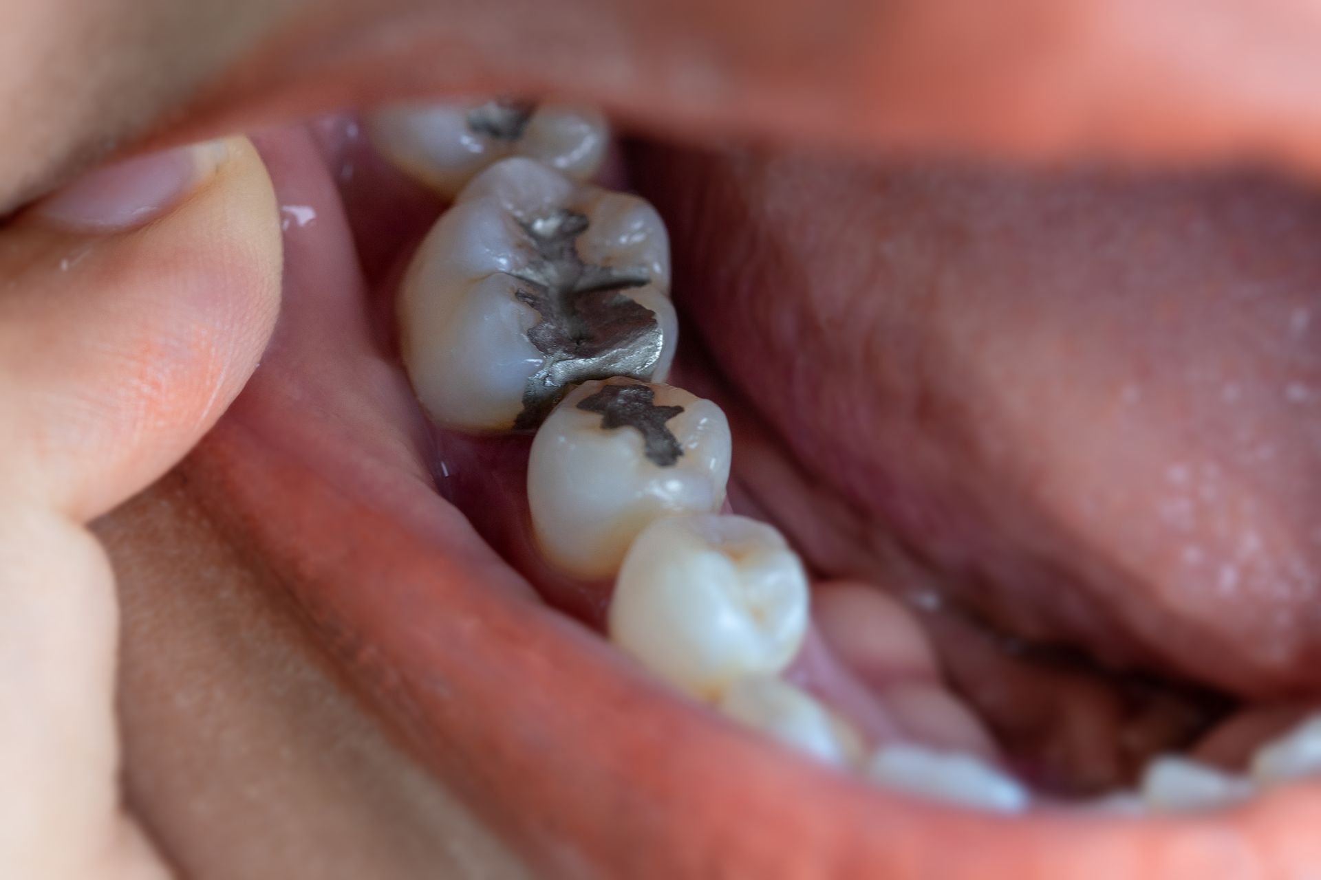 Un gros plan de la bouche d'une personne avec une dent trouée.