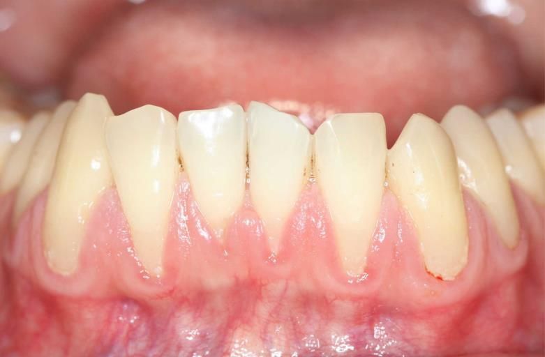 Un gros plan des dents et des gencives d'une personne.