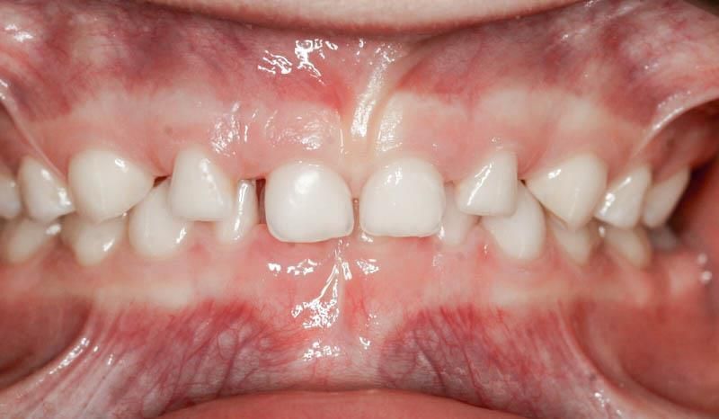 Un gros plan des dents et de la bouche d'un enfant.