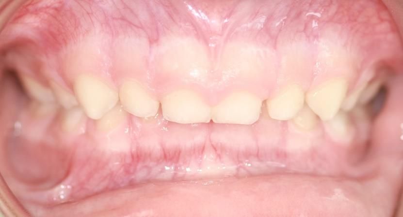 Un gros plan de la bouche et des dents d'une personne.