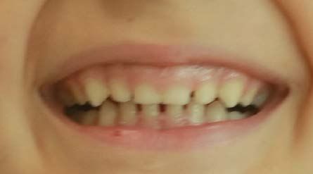 Un gros plan de la bouche d'une personne montrant ses dents.