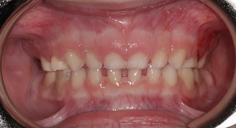 Un gros plan de la bouche d'une personne montrant ses dents