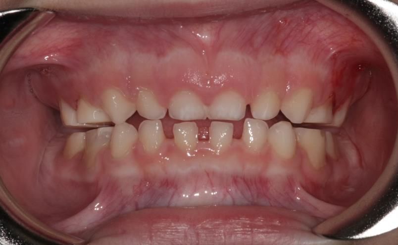 Un gros plan de la bouche d'une personne avec ses dents visibles.