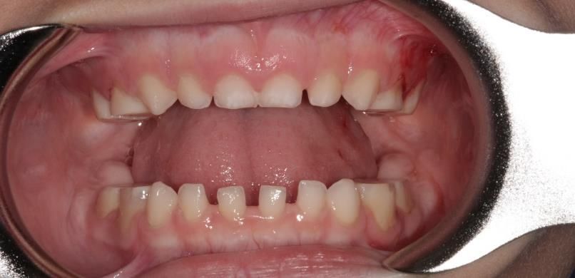 Un gros plan de la bouche d'une personne avec des dents manquantes.