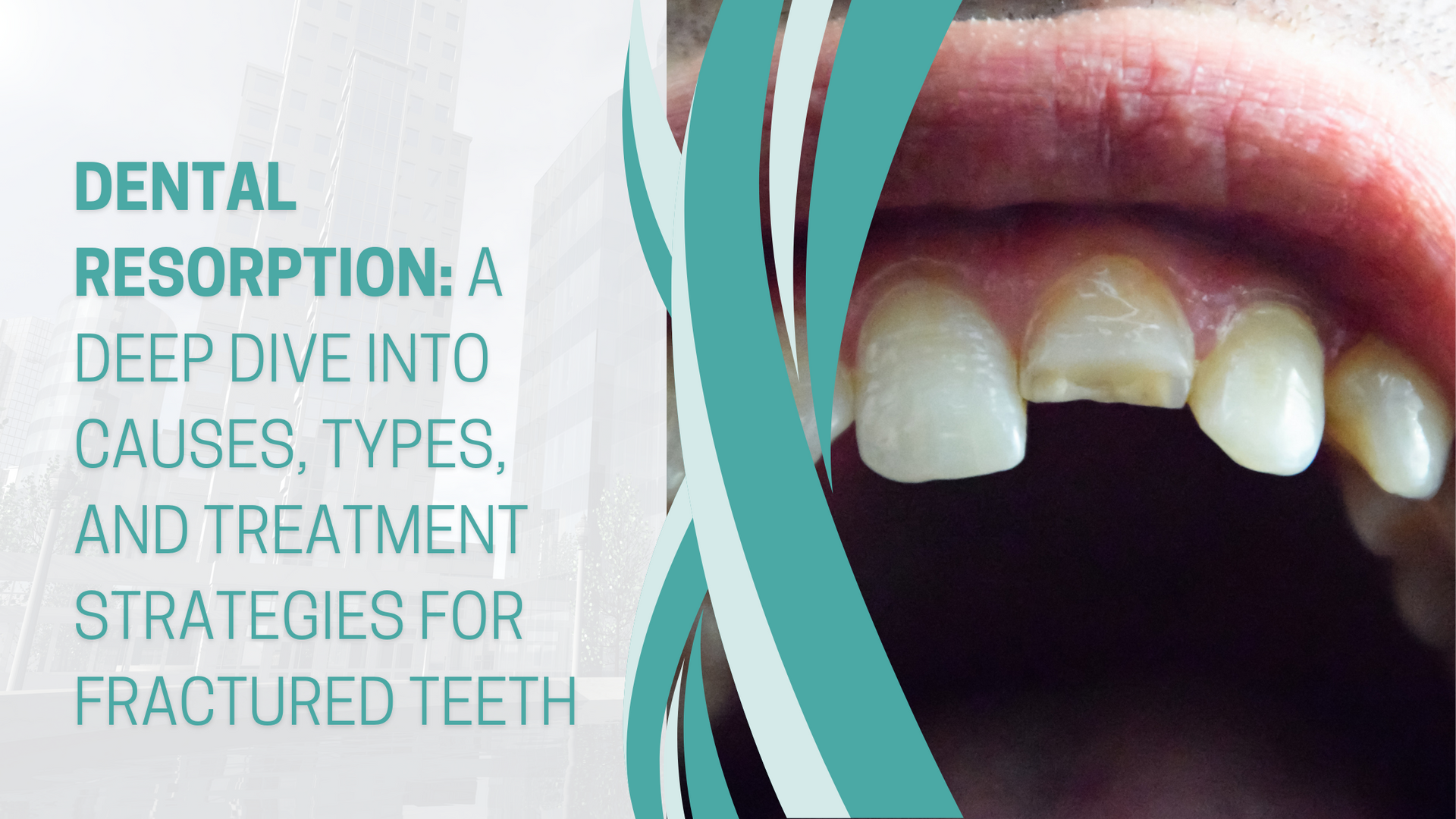 Dental resorption is a deep dive into causes , types , and treatment strategies for fractured teeth.