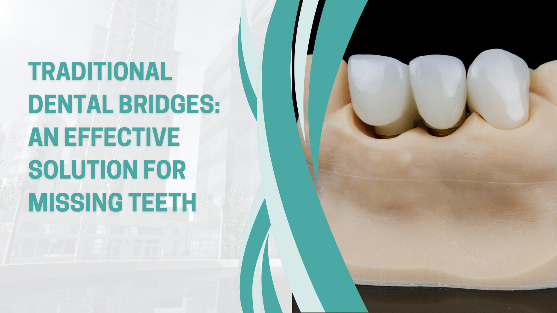 Traditional dental bridges : an effective solution for missing teeth