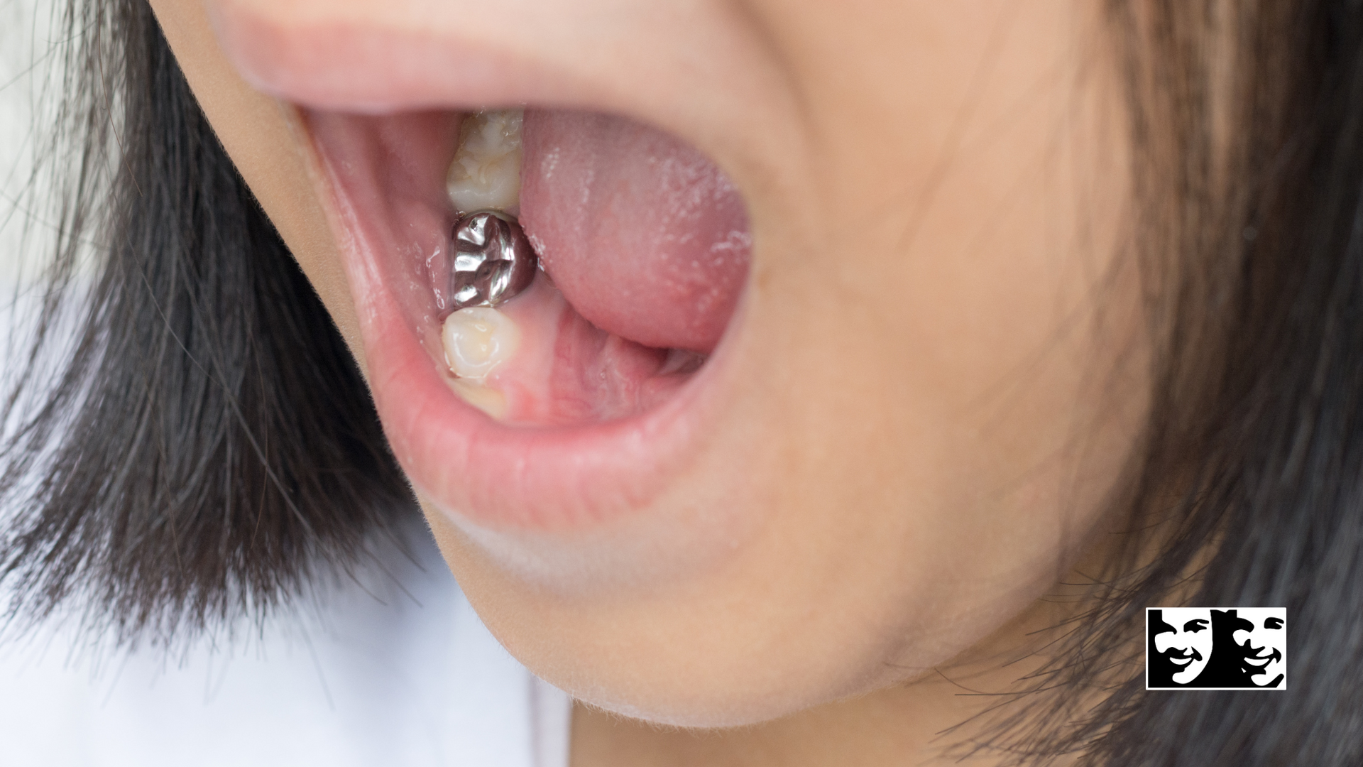 A close up of a person 's mouth with a tooth in it.