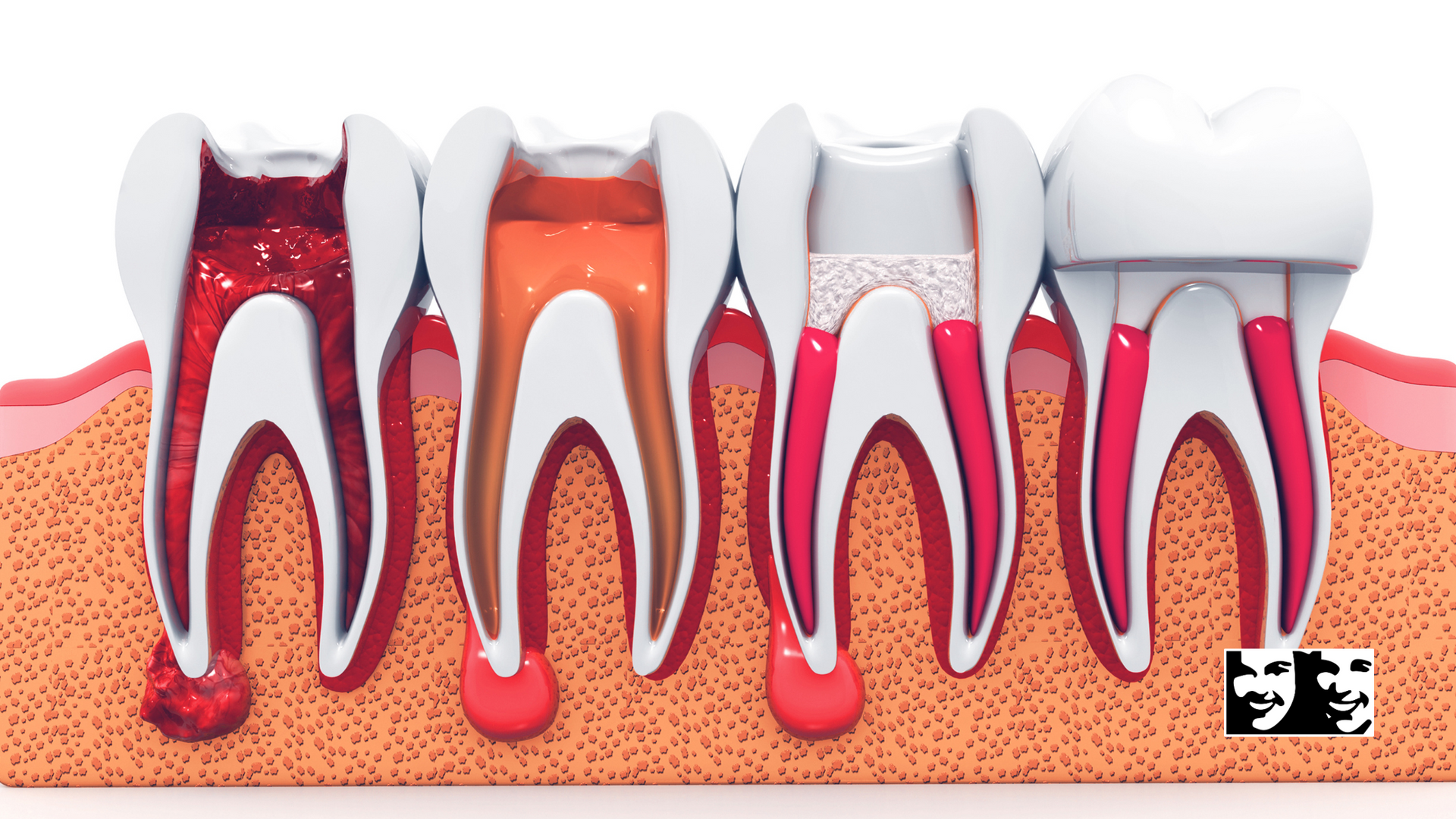 A computer generated image of a tooth being removed from the mouth.