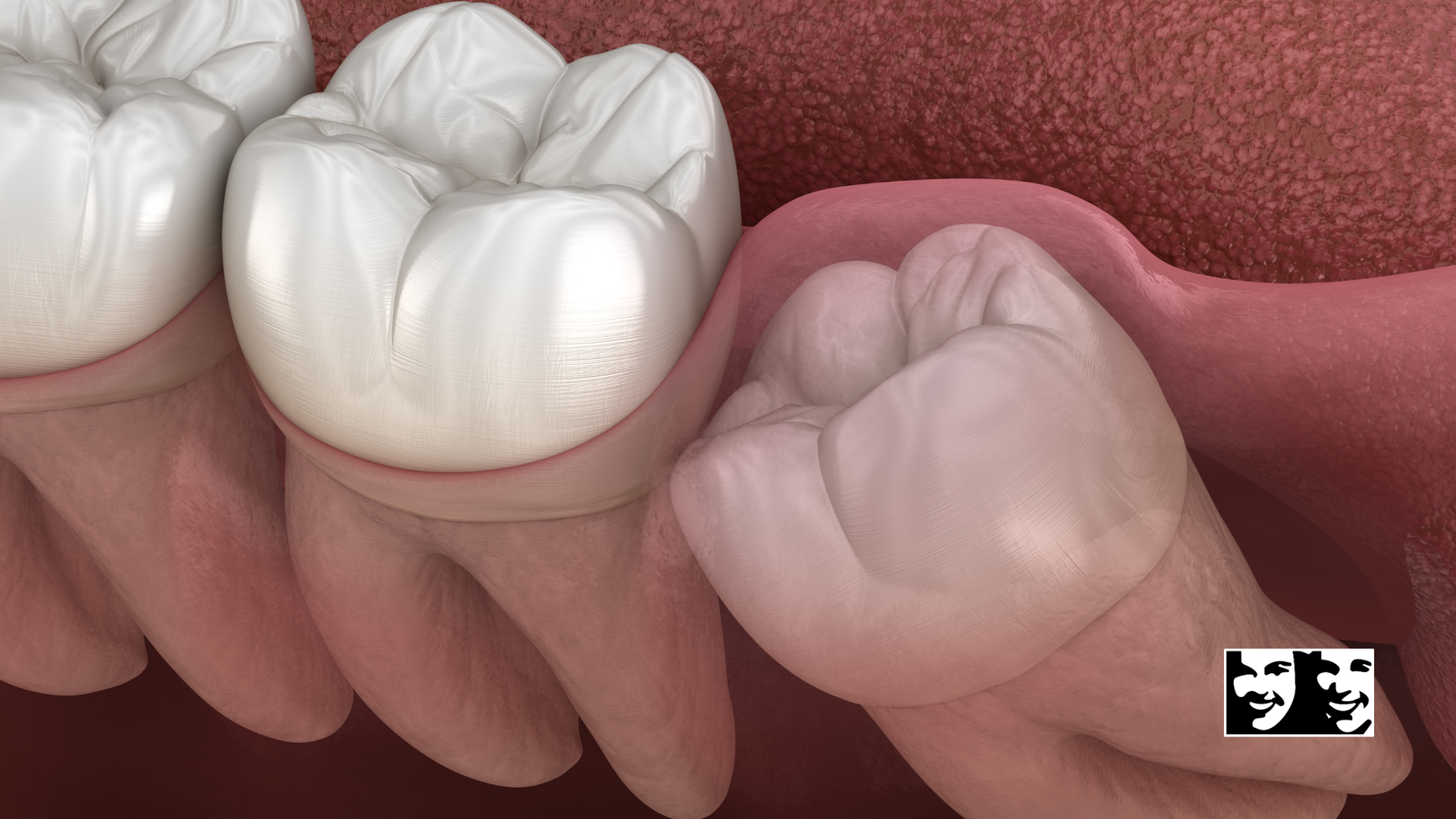 A computer generated image of a person 's teeth and gums.