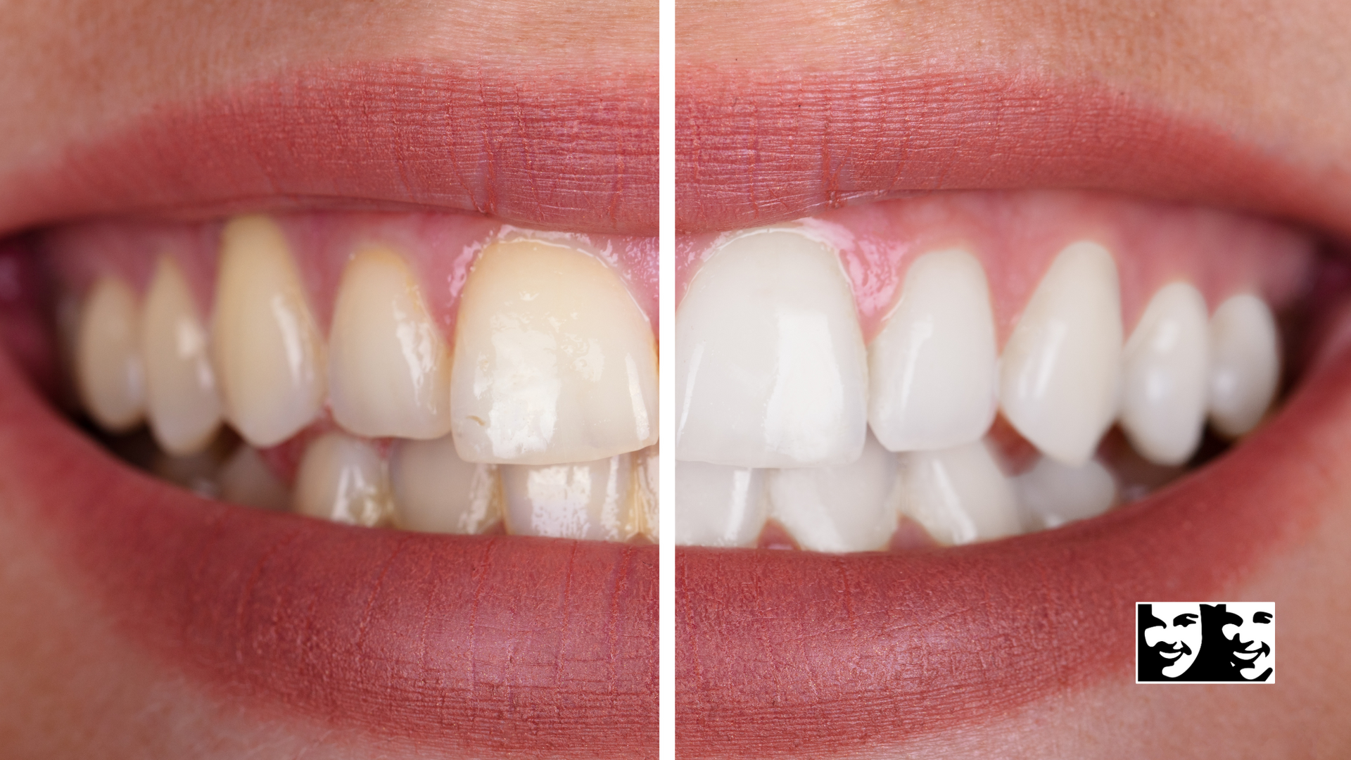 A close up of a woman 's teeth before and after whitening.
