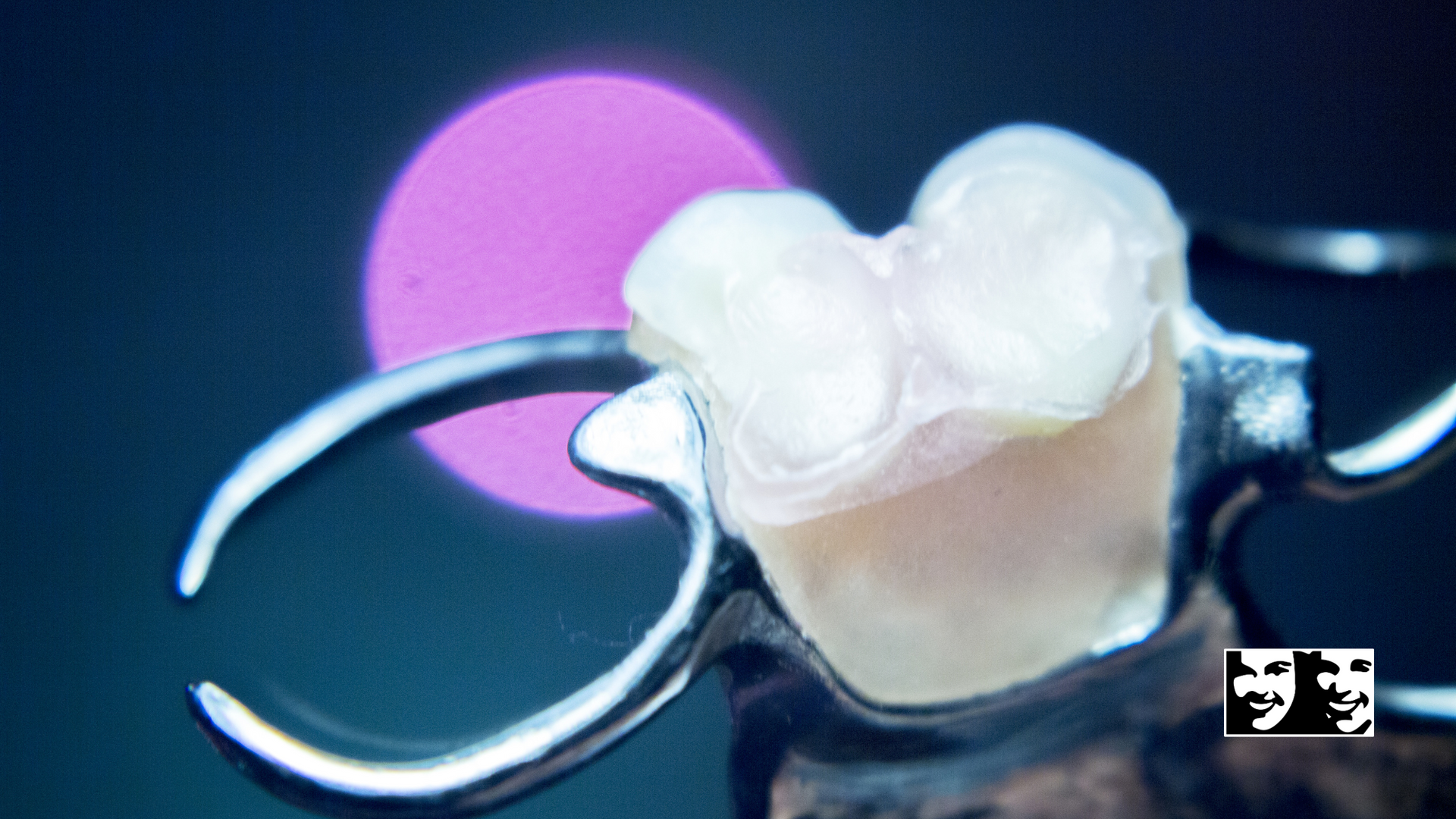 A close up of a tooth with a brace on it.