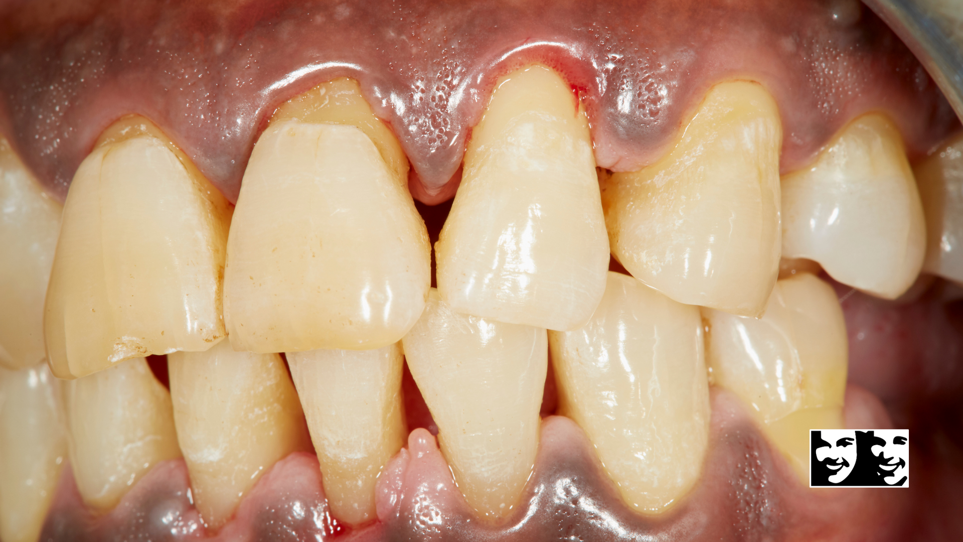 A close up of a person 's teeth with plaque on them.