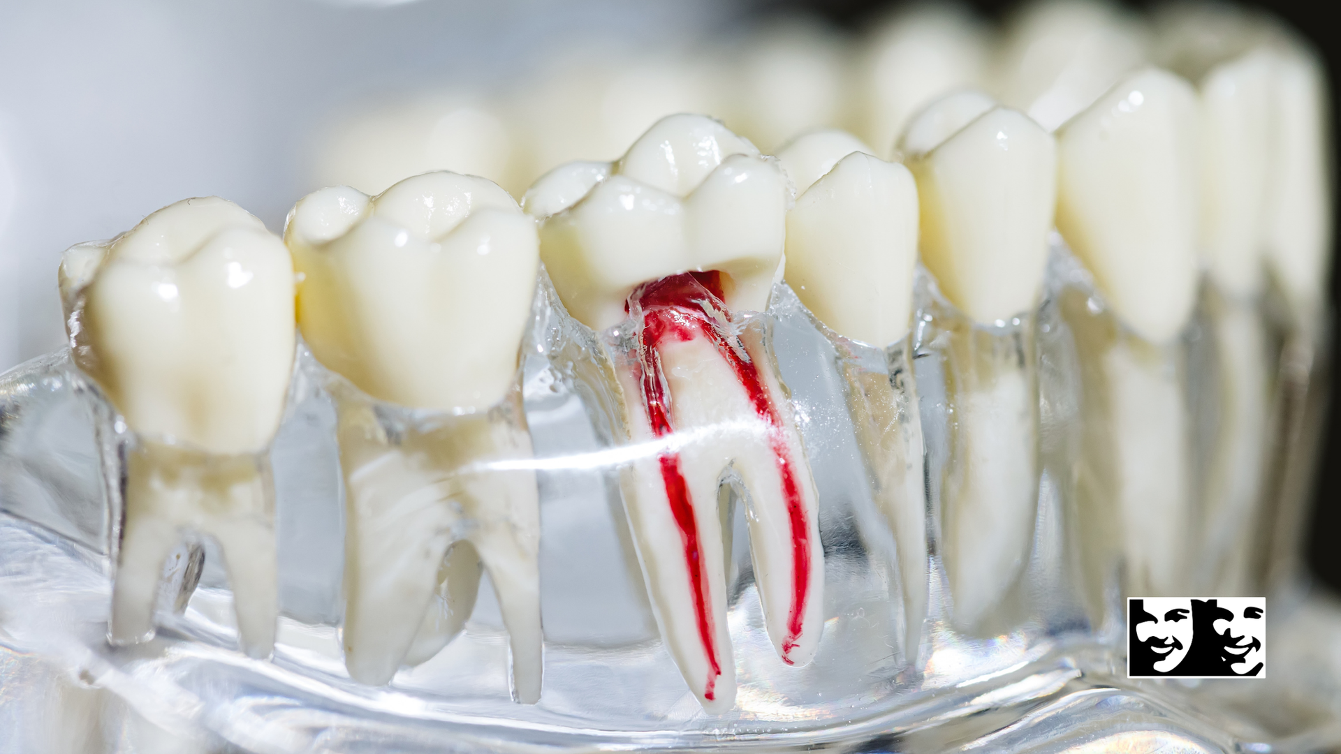 Model of teeth showing root canals highlighted in red.