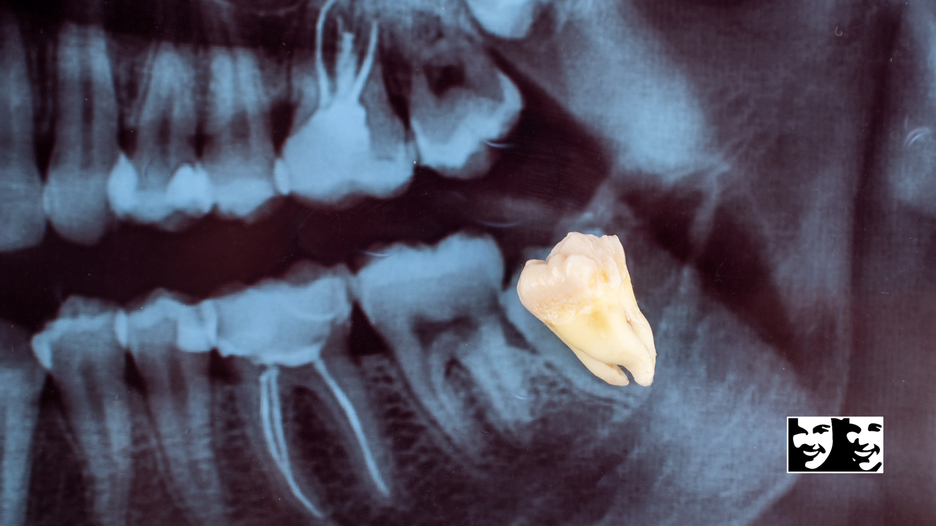 An x-ray of a person 's teeth with a tooth missing