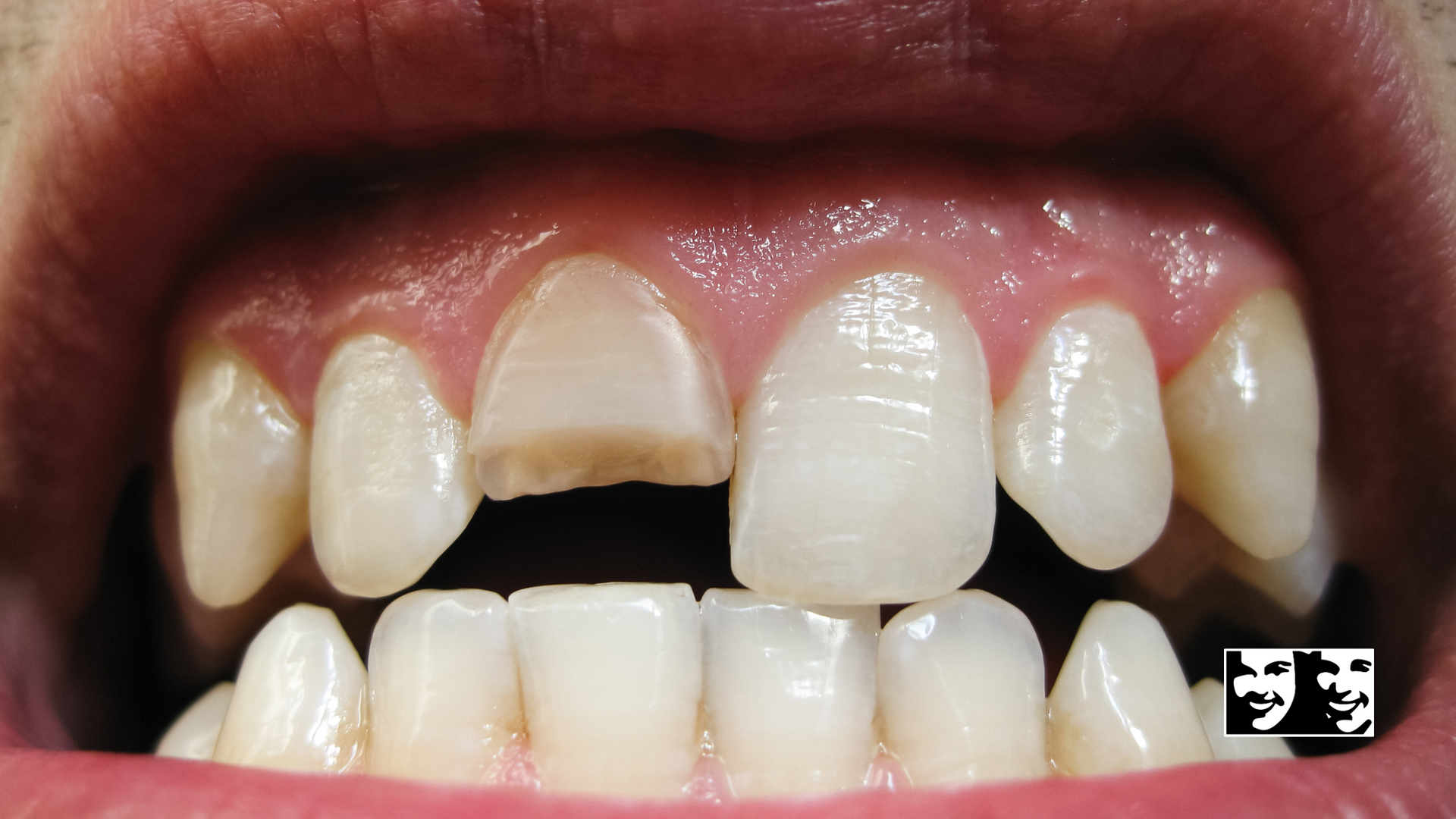 A close up of a person 's teeth with a broken tooth