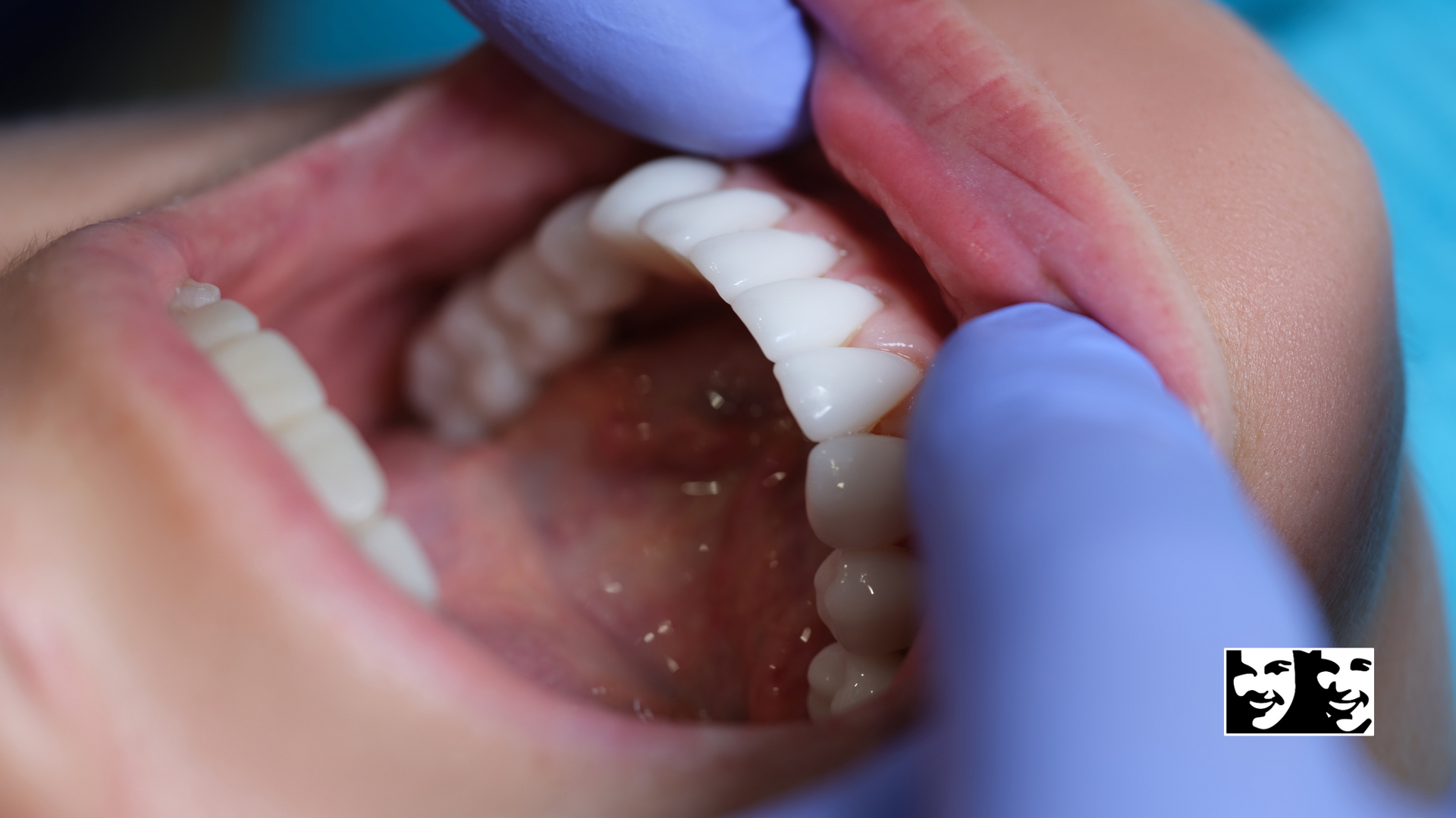 A person is getting their teeth examined by a dentist