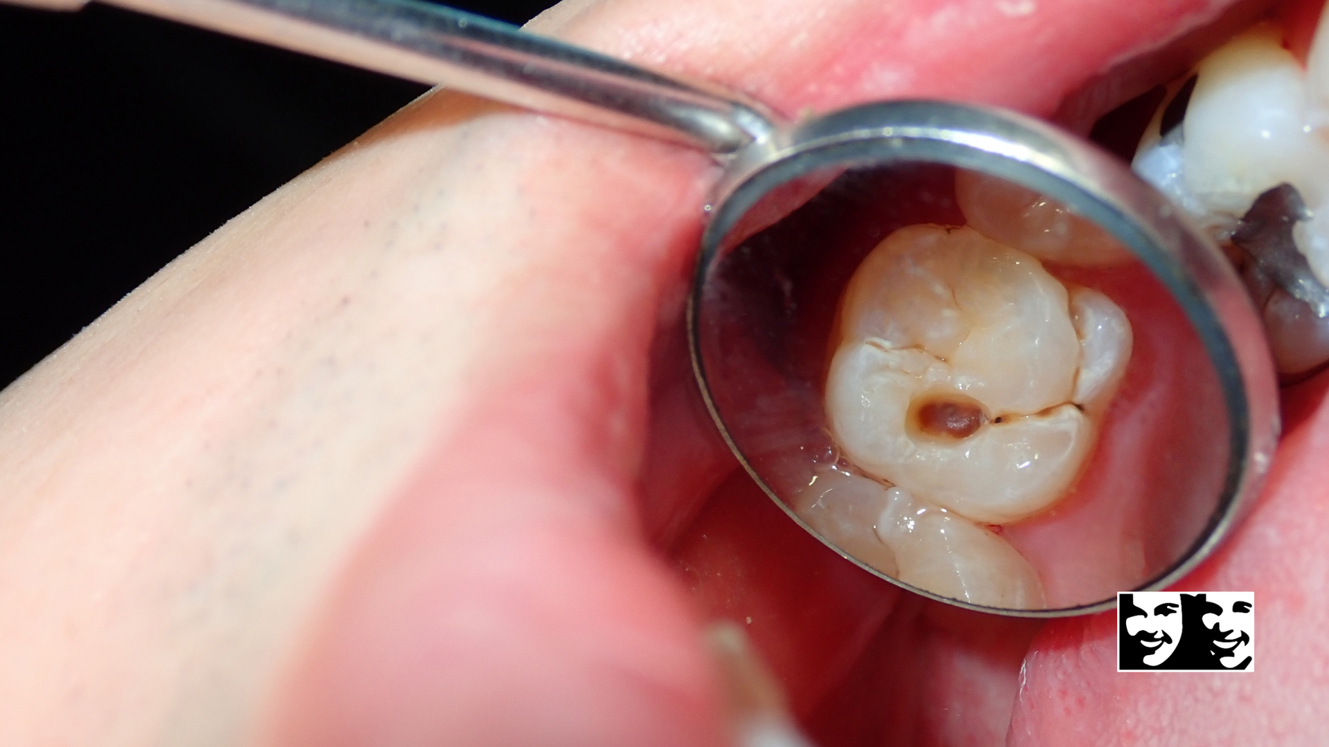 A close up of a person 's mouth with a dental mirror.