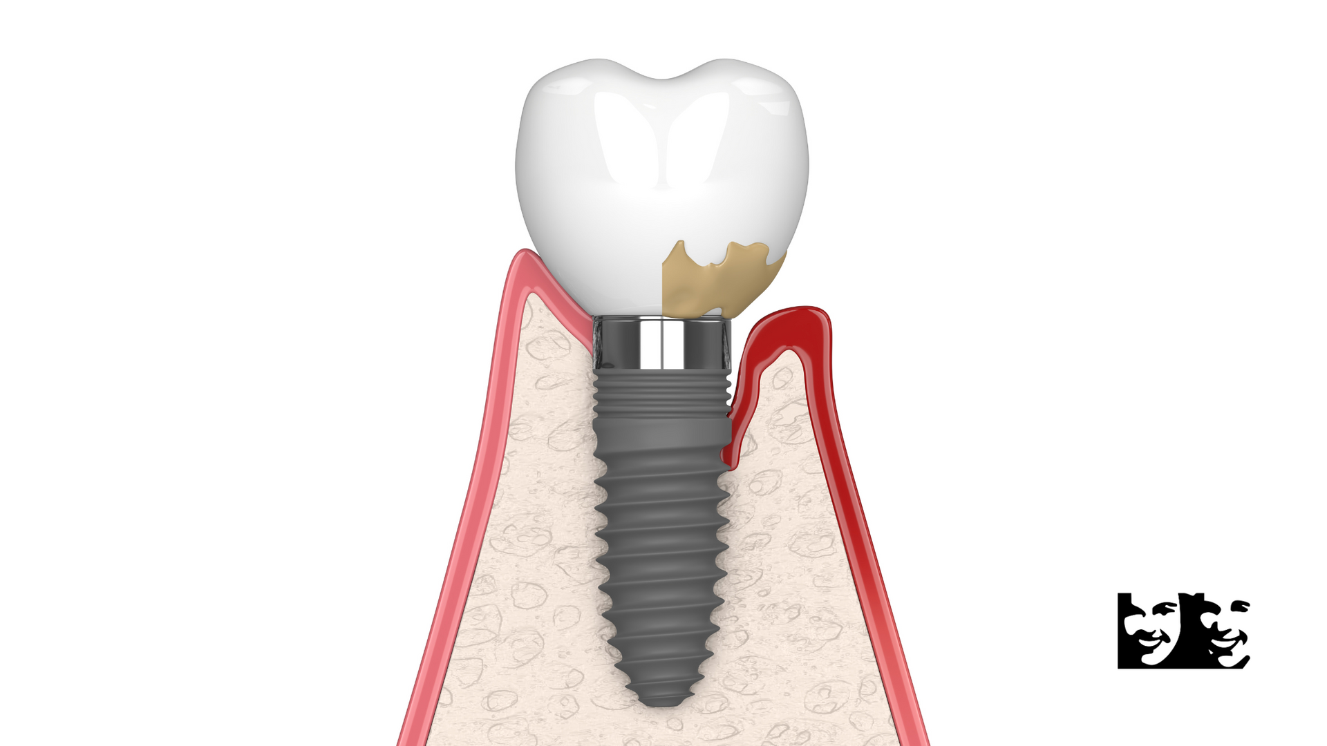 Cross-section of a dental implant, showing a screw in the jawbone with a crown and inflamed gum tissue.