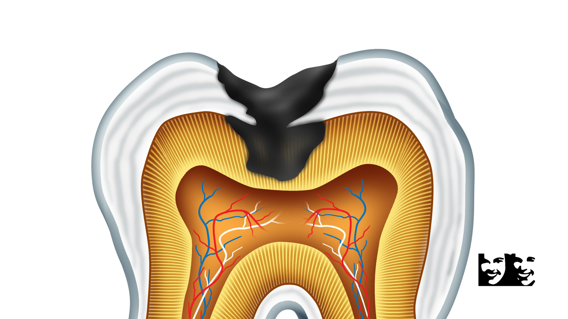 A diagram of a tooth with a black filling in it