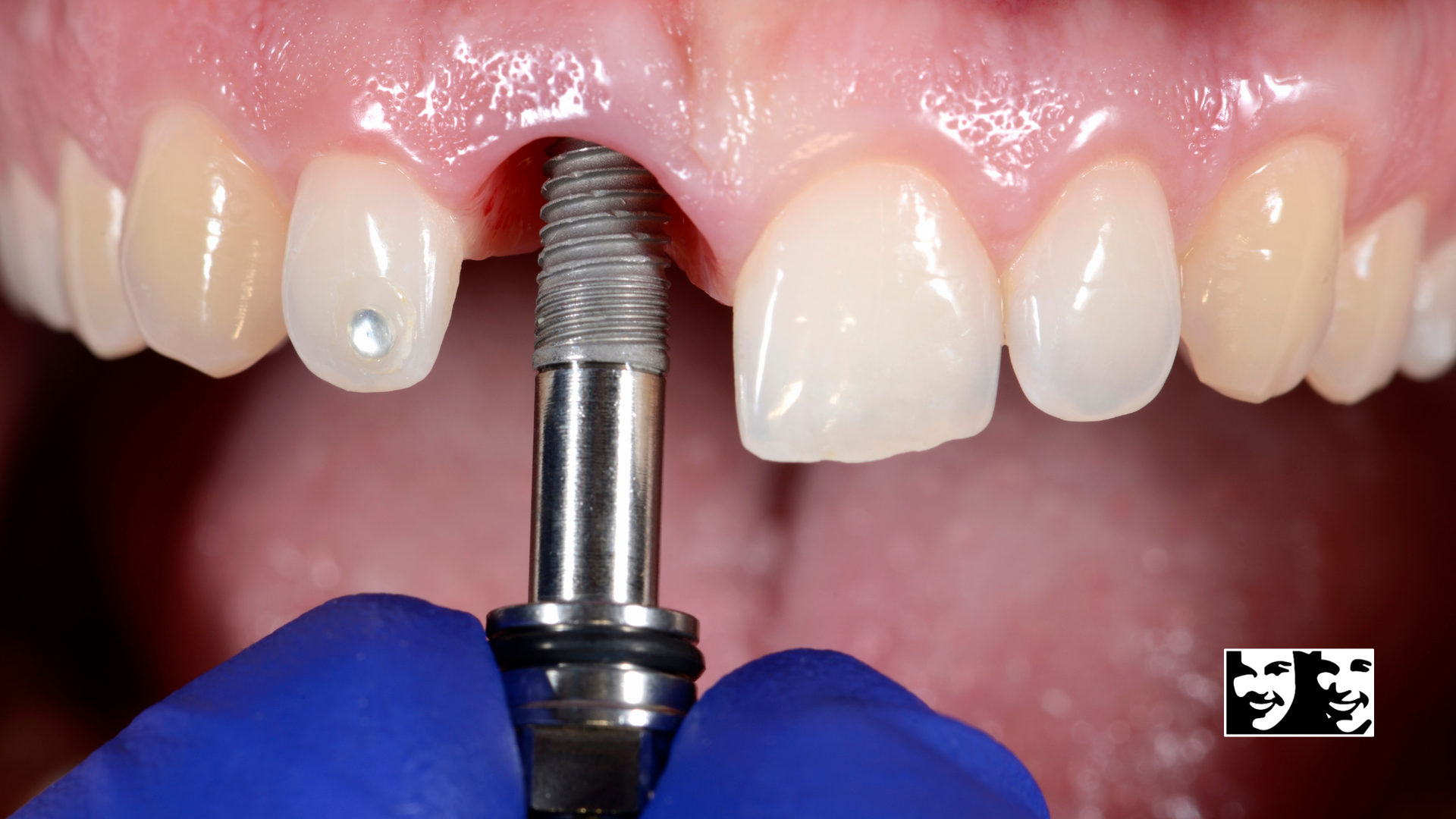A person is holding a dental implant in their mouth.