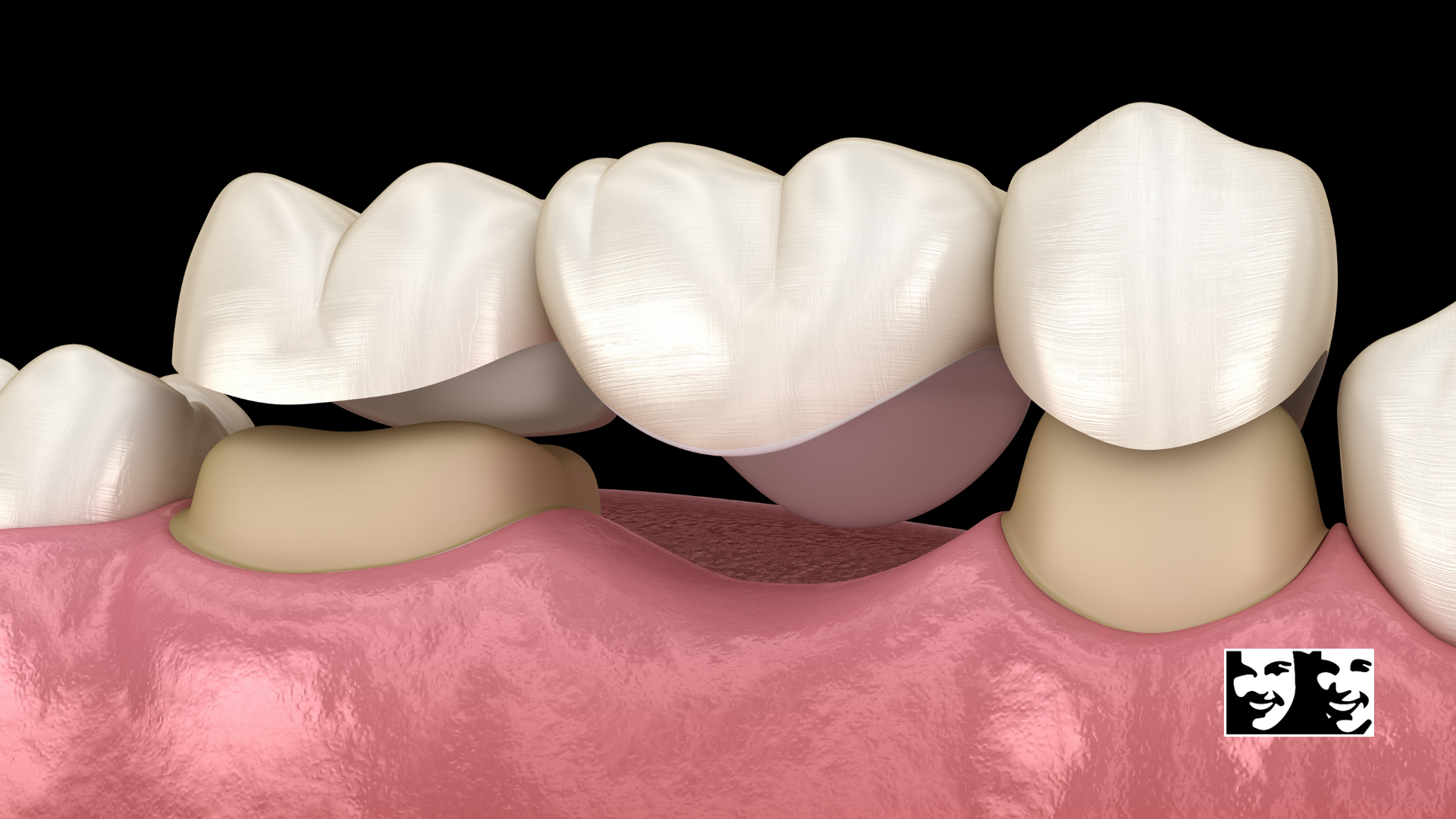A computer generated image of a dental bridge being installed