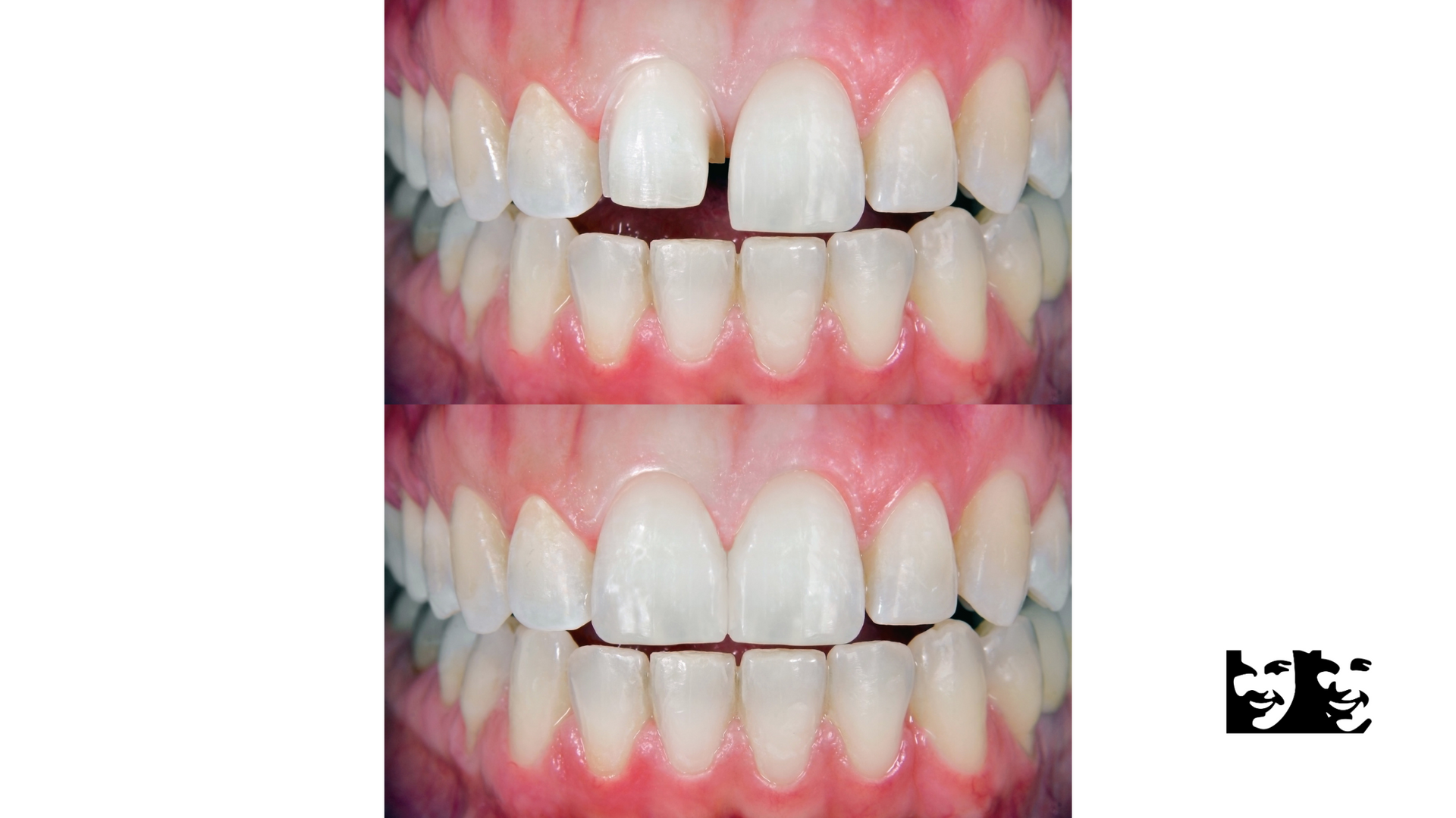 A before and after picture of a person 's teeth.