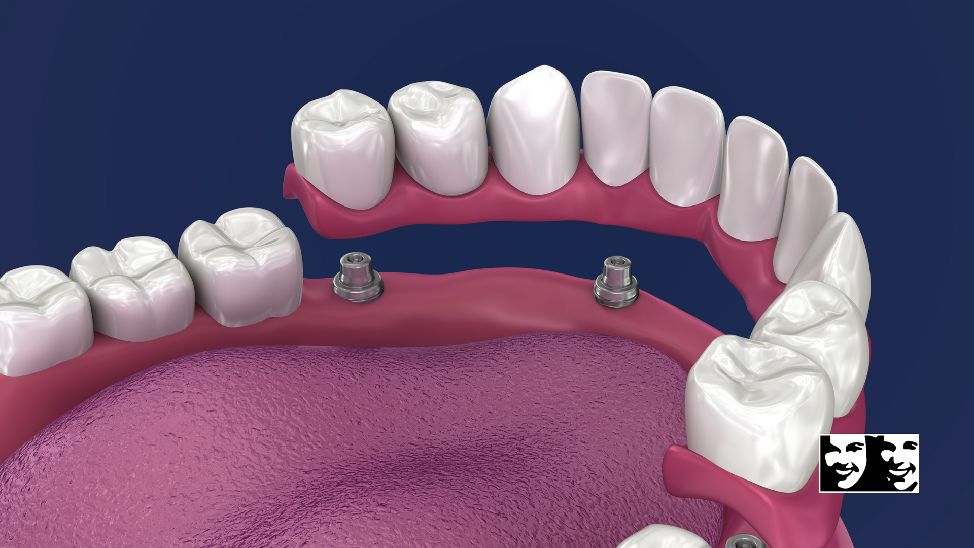 A computer generated image of a person 's teeth and gums