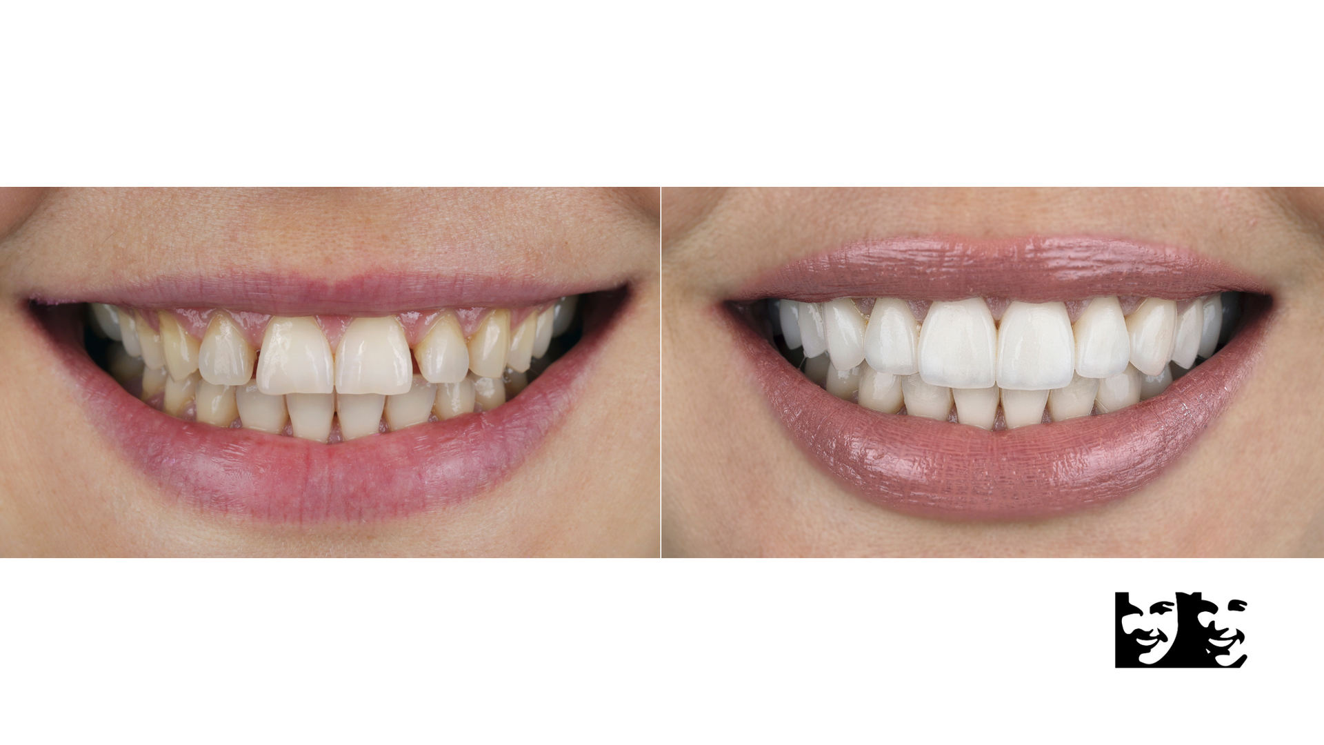 A before and after picture of a woman 's teeth