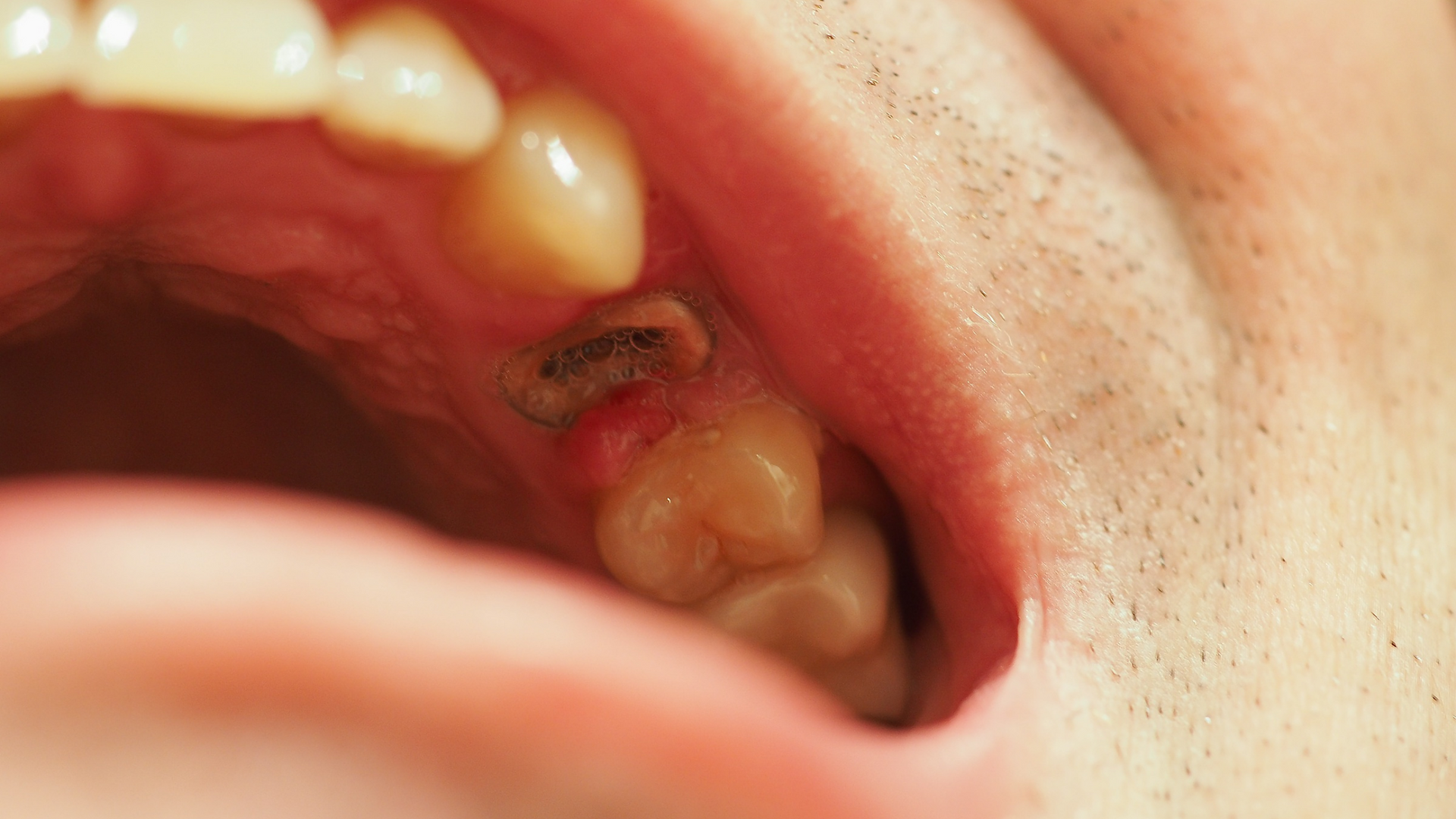 A close up of a person 's mouth with a tooth missing.