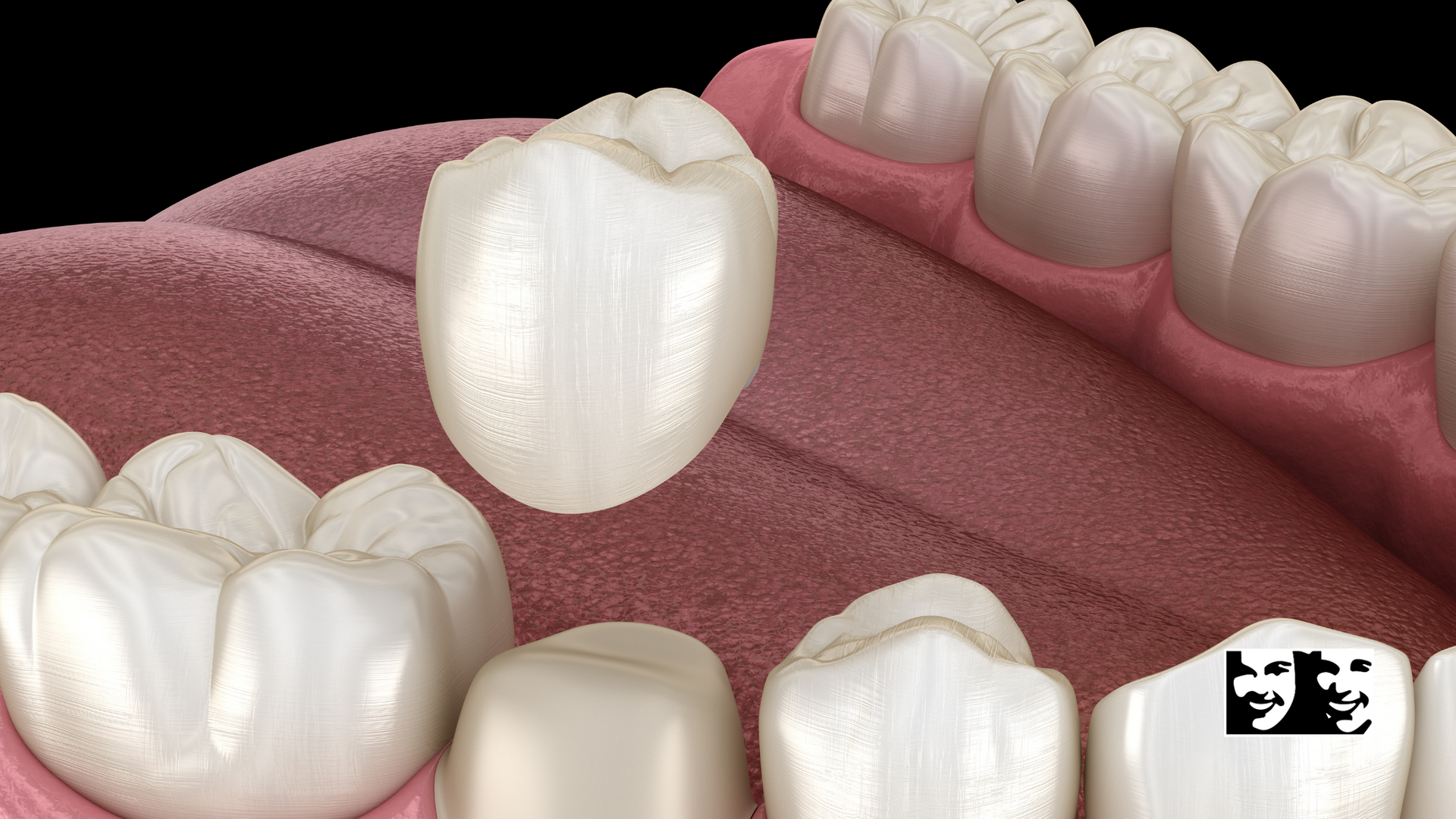 A close up of a tooth with a crown on it