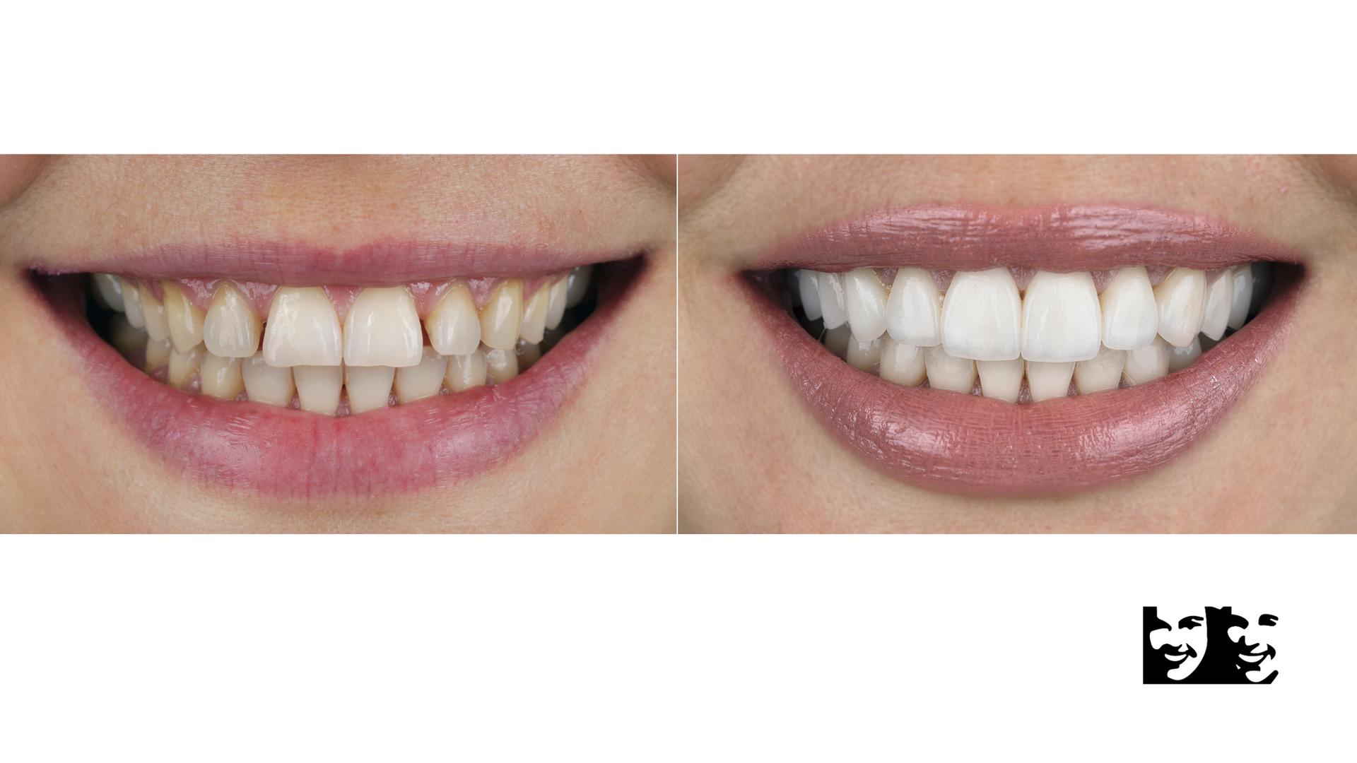 A before and after picture of a woman 's teeth.