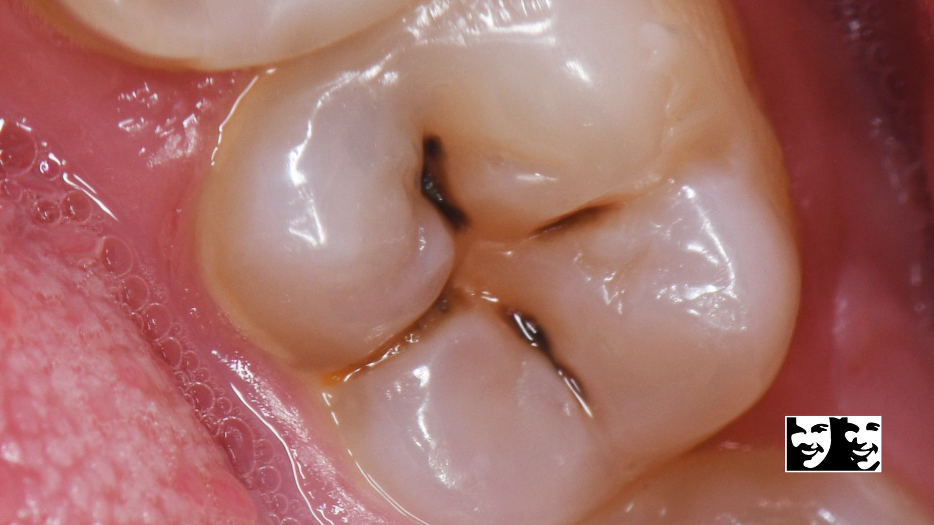 Close-up of a molar tooth with dark cracks or cavities on its surface.