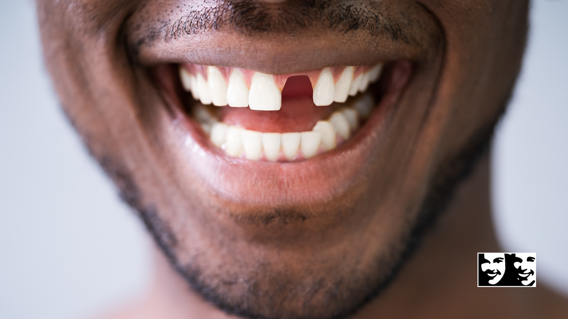 A man with a missing tooth is smiling with his mouth open.