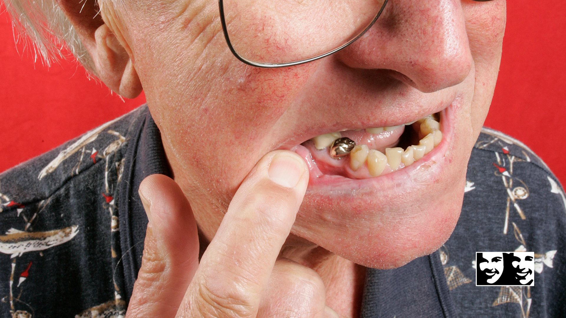 A close up of a man 's mouth with a tooth missing