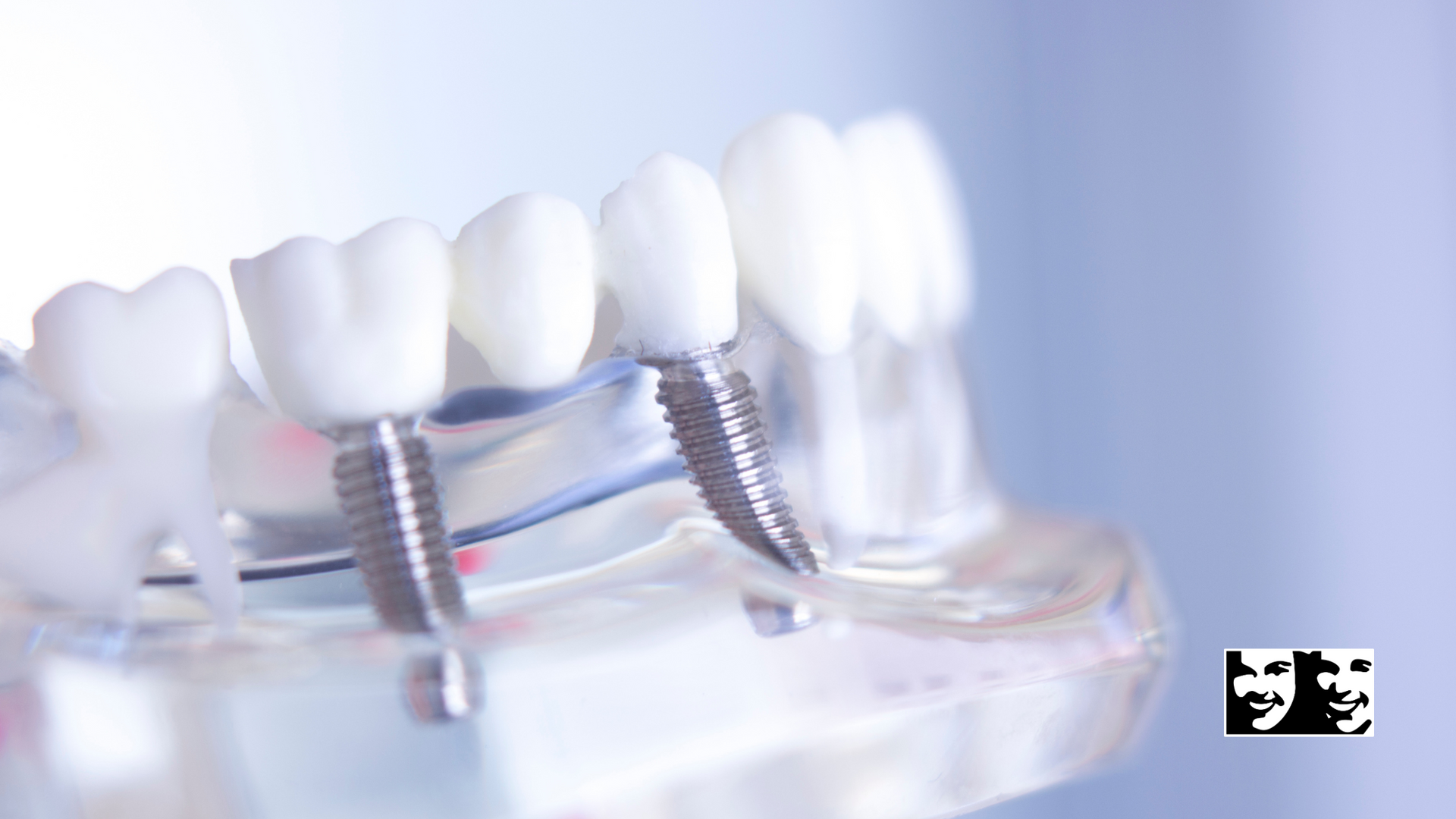 Dental model showing teeth with implants and abutments.