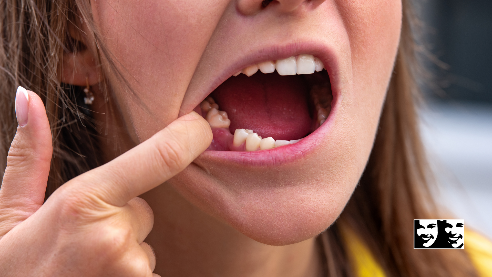 A woman is pointing at her missing tooth in her mouth.
