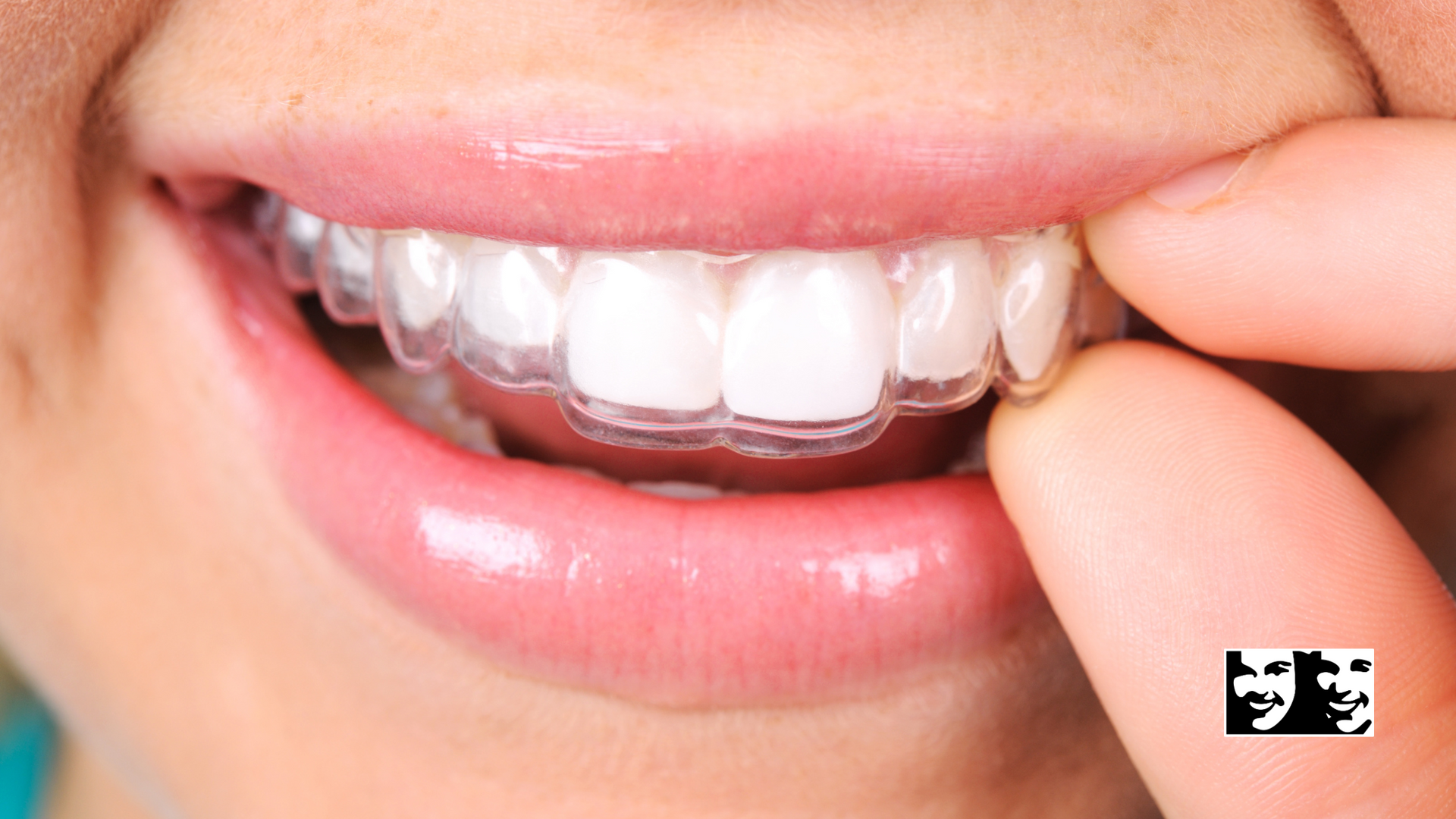 Person inserting clear Invisalign aligner into their teeth.