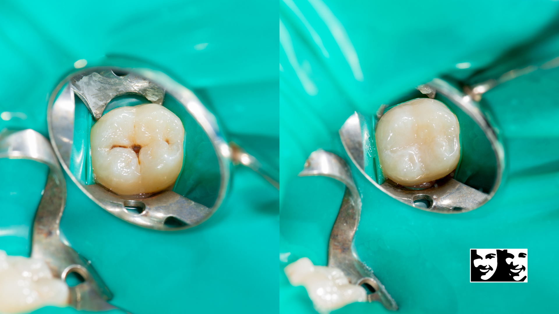 A tooth with a hole in it is being examined by a dentist.