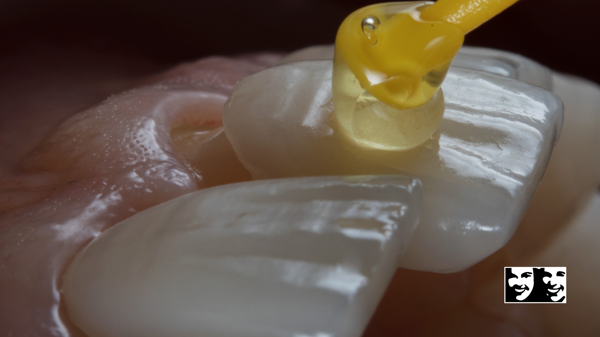 A close up of a tooth with a yellow object on it