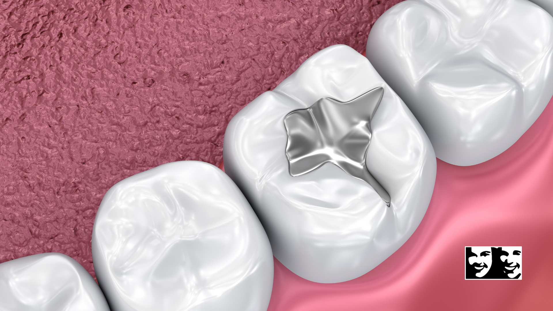 A close up of a tooth with a filling in it.