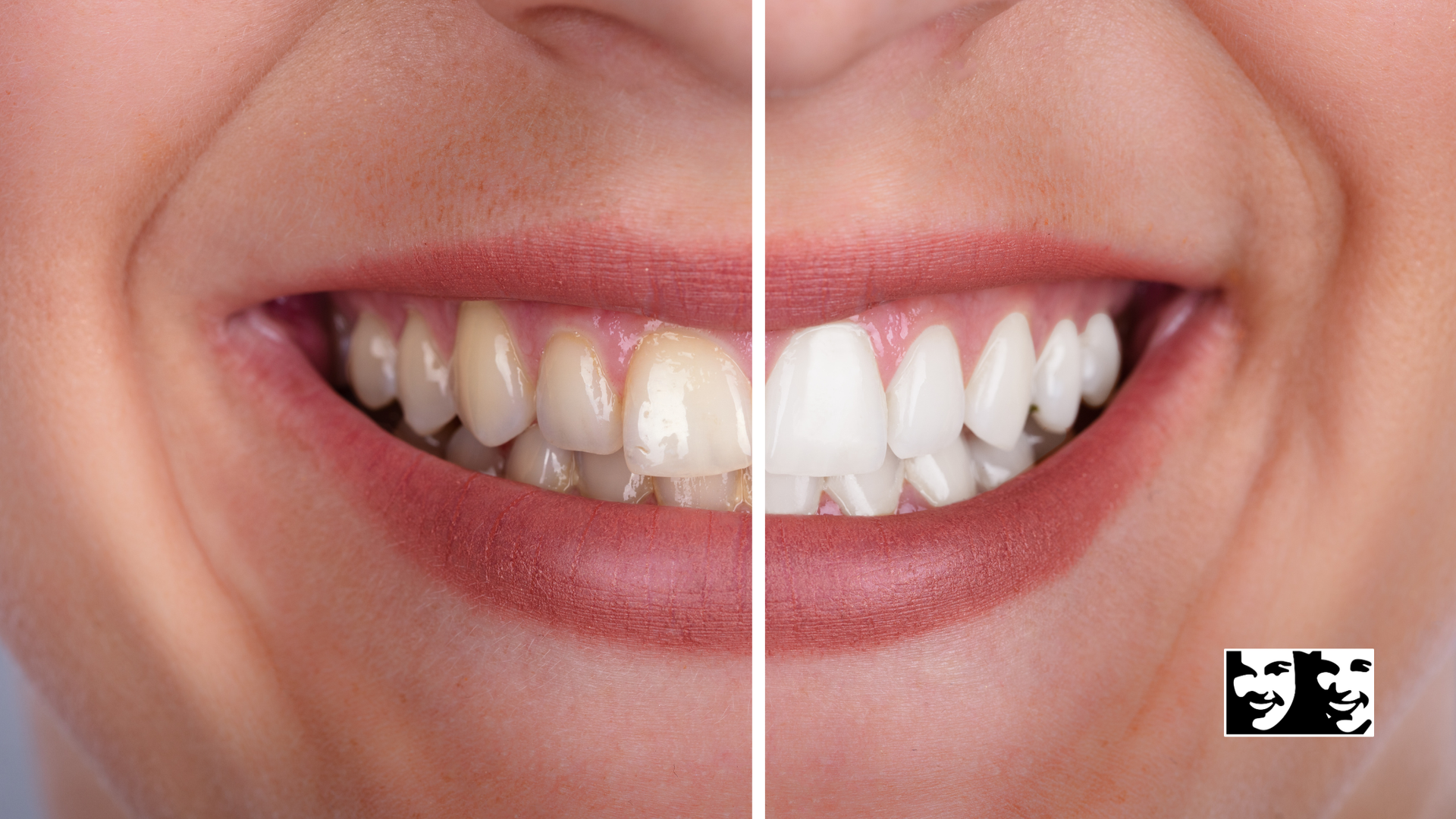 Close-up of a smiling mouth with teeth comparison, showing yellowed teeth beside whiter teeth.