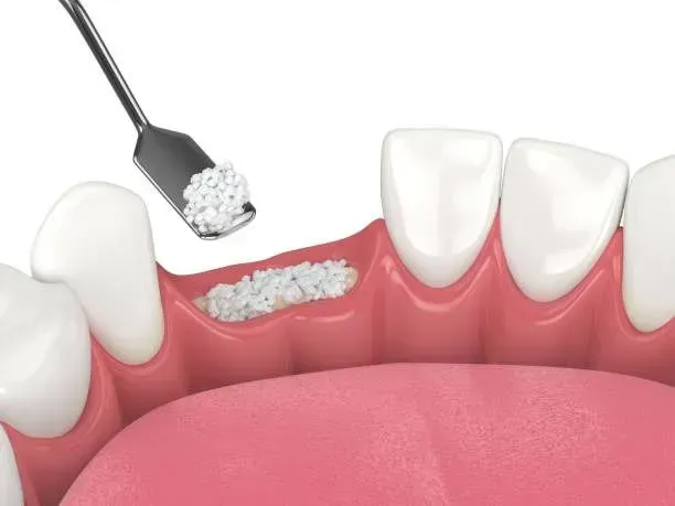 Dental tool placing white granules into a gum pocket on a mouth model