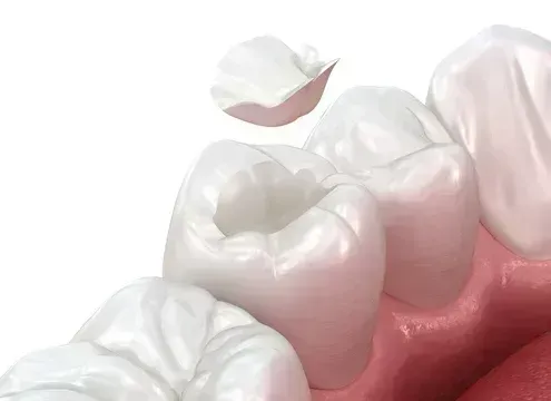 Close-up of white molars with a small loose tooth above the gums