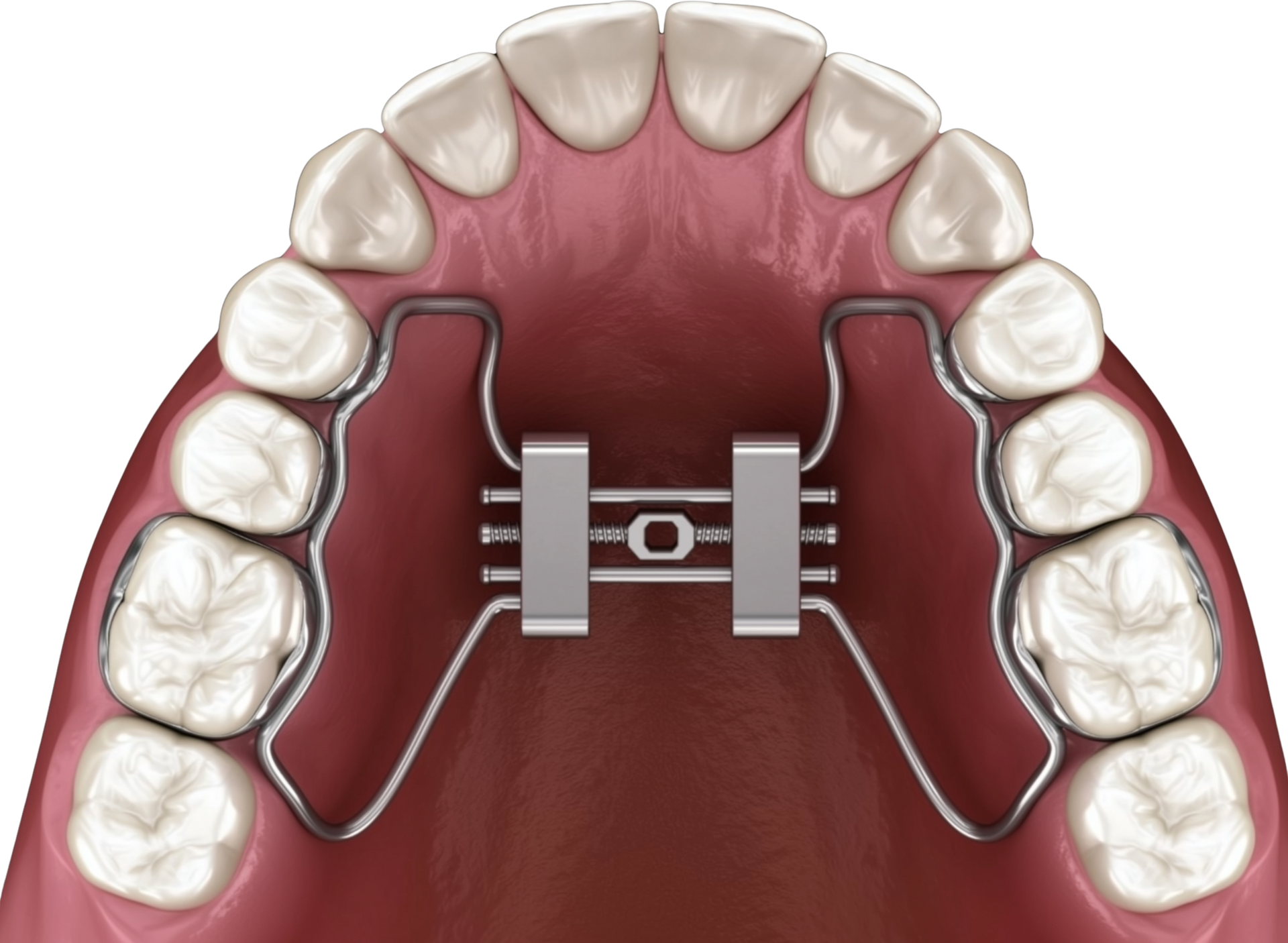 Upper view of upper teeth with a palatal orthodontic expander on the roof of the mouth