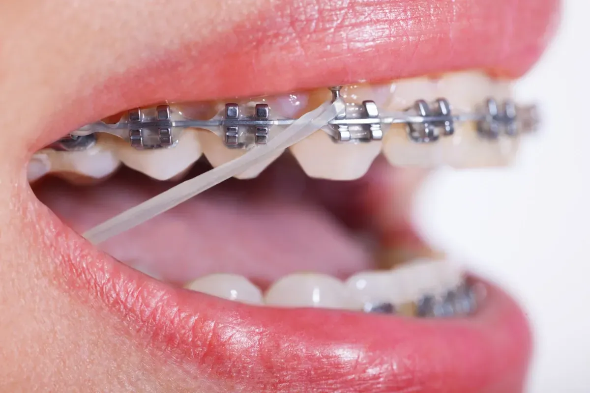 photo of elastics