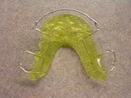 photo of Hawley retainer