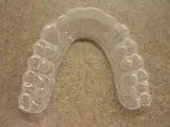 photo of invisible retainer