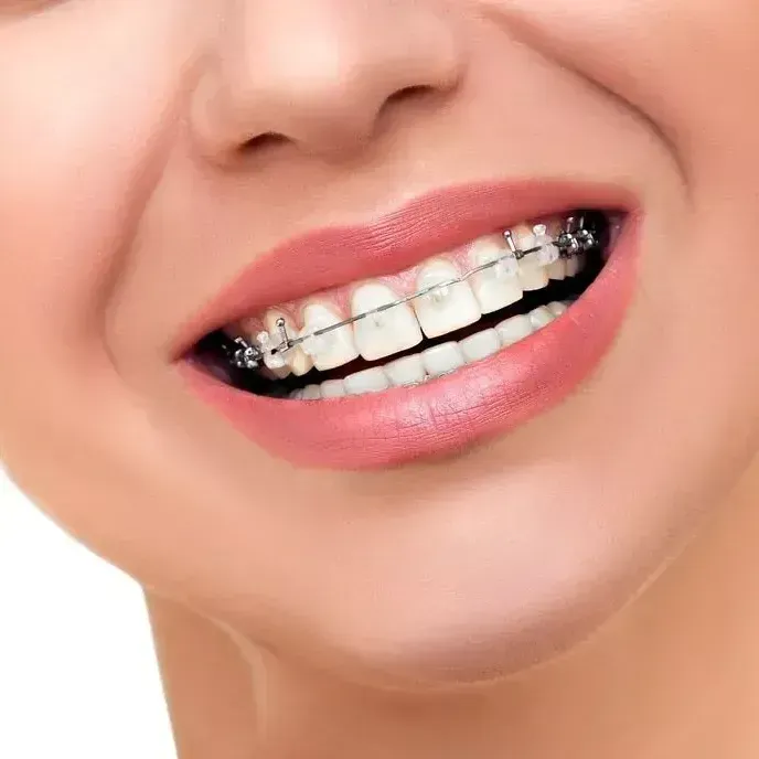 TOOTH WHITENING OPTIONS FOR PEOPLE WITH BRACES