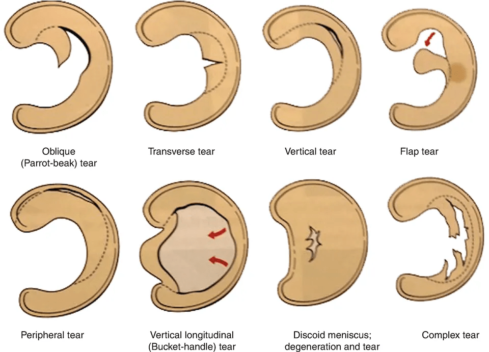 Knee Meniscus | Align Orthopaedics | South Brisbane